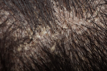 macro view of hair root or scalp with dandruff, seborrheic dermatitis
