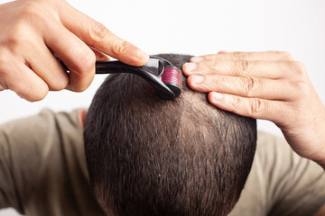 collagen induction therapy hair loss treatment