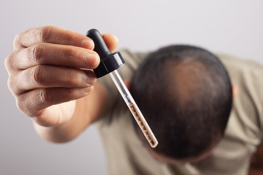 bald man showing minoxidil dropper or essential oil