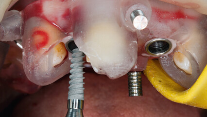 dental implant through a special surgical template on the upper jaw © Dental Pro Content