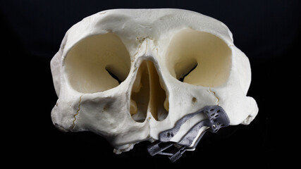 dental skull with zygomatic metal template for zygomatic implants
