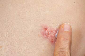 Herpes Zoster (shingles) on the skin, close up. Medicinal ointment for treatment