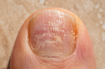 Fungal nail infection of the big toe
