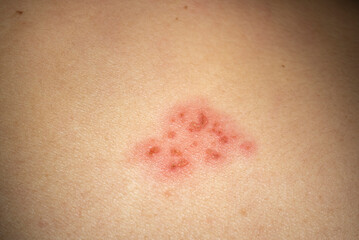 Herpes Zoster (shingles) on the skin, close up.