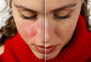 Face of young woman before and after removal of acneiform rosacea