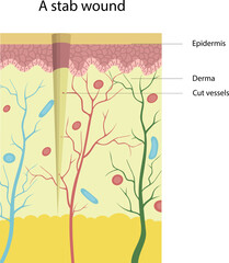 Vector illustration of the structure of a stab wound. Cut vessels. Skin injuries.