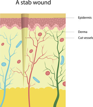 Vector Illustration Of The Structure Of A Stab Wound. Cut Vessels. Skin Injuries.