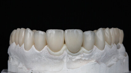 excellent dental veneers and ceramic crowns on the model of the upper jaw on a black background