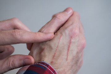 Close up - man showing hand with cat scratches on skin. Pain, damaged, inflammation, injury concept