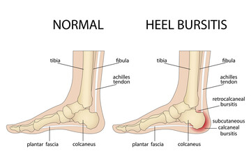 Calcaneal bursitis. Foot with normal heel and foot with Haglund's deformity and bursitis