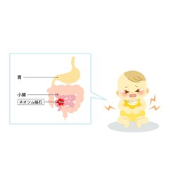 玩具(マグネットパズル)が破損し内蔵されていたネオジム磁石が腸管壁を穿孔する場面を説明するイラスト
