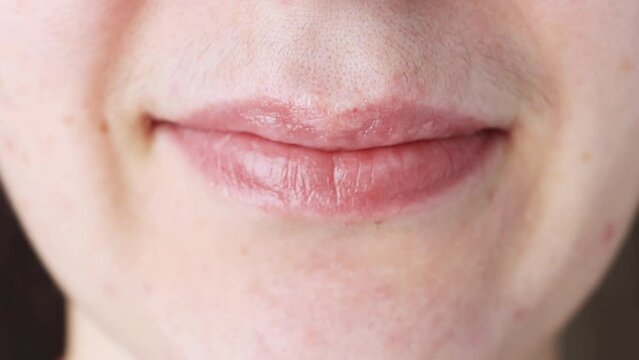 Close-up of a female face with black mustache hair, a sick girl with abnormal metabolism and increased testosterone.