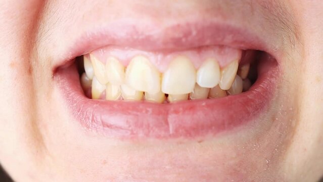 Close-up of a person's mouth with malocclusion and tooth placement. Problem in the mouth.