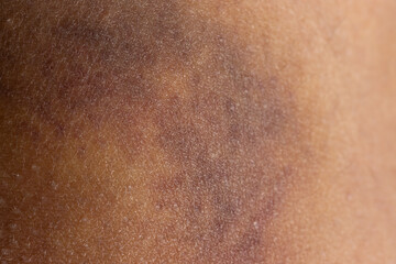 bruise on the skin of the leg as a background
