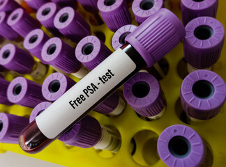 Technologist holding test tube with blood sample for Free PSA(Prostate specific antigen) test,  diagnosis of prostate cancer, laboratory background