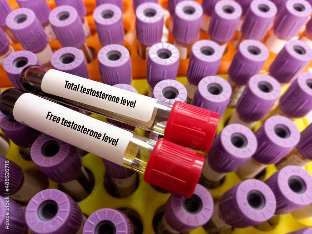 Poster Blood sample tubes with sample for Testosterone(Total and Free) test. Healthcare or medical concept. Male sex hormone, lavender test tube background.