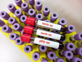 Blood sample tube with sample for PSA (Total, Free, p2) test. Prostate specific antigen, diagnosis of prostate cancer, close view