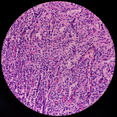 Urinary bladder(biopsy): Chronic cystitis, microscopic show bladder mucosa, infiltration of inflammatory cells in the lamina propria, interstitial cystitis