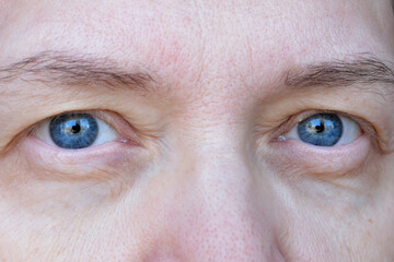 middle aged female's eye with drooping eyelid. Ptosis is a drooping of the upper eyelid, lazy eye....