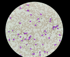 1000x, abnormal, acute, all, aml, analyzing, apl, blast, blood, bone, cancer, care, cbc, cell,...