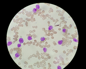 1000x, abnormal, acute, all, aml, analyzing, apl, blast, blood, bone, cancer, care, cbc, cell,...