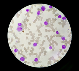 Acute Promyelocytic Leukamia (APL) analyzed by microscope. It is an aggressive type of acute...