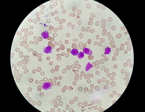Acute Promyelocytic Leukamia (APL) analyzed by microscope. It is an aggressive type of acute myeloid leukemia.