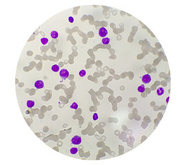 Acute Promyelocytic Leukamia (APL) analyzed by microscope. It is an aggressive type of acute...