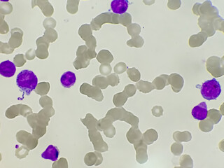 Acute Promyelocytic Leukamia (APL) analyzed by microscope. It is an aggressive type of acute...