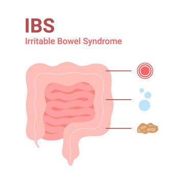 Irritable Bowel Syndrome, IBS. Symptoms In Intestine Pain, Bloating And Diarrhea. Vector Illustration