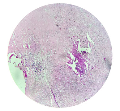 Carcinosarcoma of gallbladder. Histology analyzed by microscope. Gallbladder cancer
