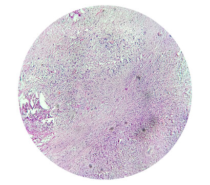 Carcinosarcoma of gallbladder. Histology analyzed by microscope. Gallbladder cancer
