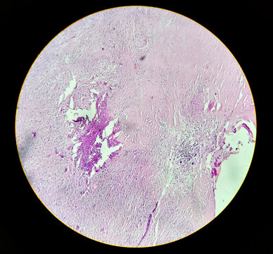 Carcinosarcoma of gallbladder. Histology analyzed by microscope. Gallbladder cancer