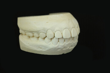 Dental model full mount for dental treatment plan