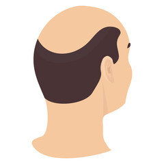 Head of a man with hair loss in side view. Different stages of alopecia in men. Health care and beauty concept. Vector cartoon illustration