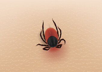 forest ixode tick. stuck to the human skin. the risk of infection with tick-borne encephalitis, lyme borreliosis and granulocytic anaplasmosis