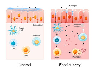 food allergy.  development of an allergic reaction - obrazy, fototapety, plakaty