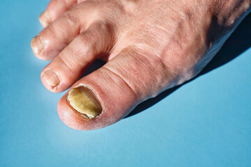 Onychomycosis, a nail disease caused by pathogenic fungi. Copy space for text