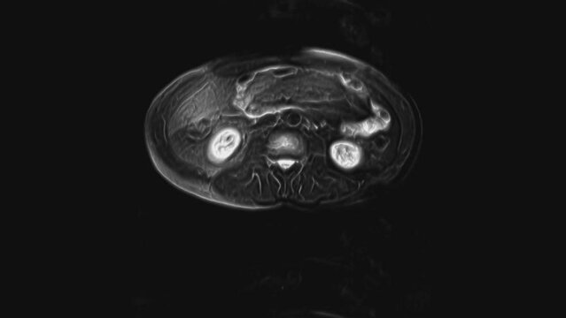 Voluminous CT scan of the abdomen. Computed tomography of the gastrointestinal tract, liver and kidneys