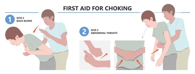 Choking first aid baby food CPR child step lodges blocking victim adult help abdomen kids conscious poster swallow back blows chest rescue breath care safety - obrazy, fototapety, plakaty