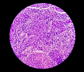 Photomicrograph of Nasopharyngeal carcinoma, nasopharynx cancer, most common cancer originating in the nasopharynx