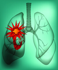 The illustration of rentgenogramma or x-ray of sick lungs with a great sickness in them. This can be useful as a medical concept. Vector illustration.