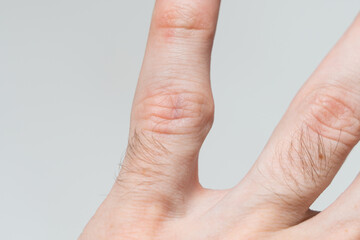 A protruding bone on the finger of the hand. Incorrect bone fusion. Recovery after a broken finger. Problems with genetics. Improper metabolism. Macro.
