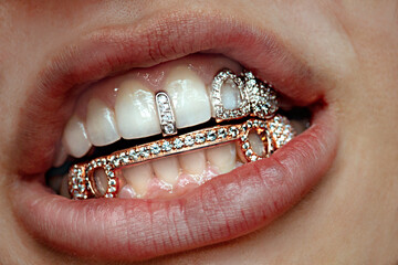 Grillz - Dental Jewelry 