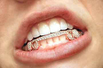 Grillz - Dental Jewelry 