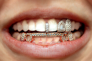 Grillz - Dental Jewelry 