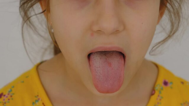 The child has stomatitis on the lip. Selective focus.