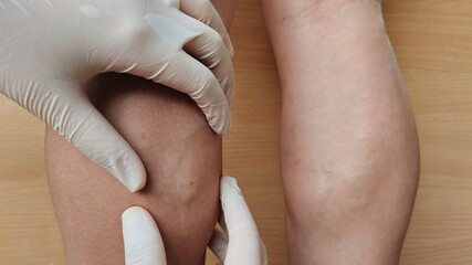 Portrait treatment the calf muscles and blood vessels on the legs of woman, concept health care.