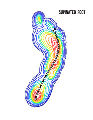 Supinated foot, arch deformation, bottom view. Foot weight distribution.