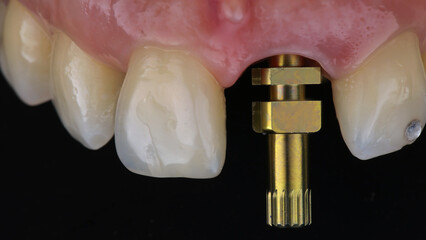 dental macro photo with analog transfer in the central tooth before installing the crown